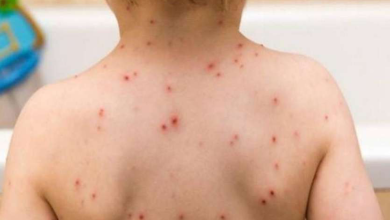 Photo of जानिए खसरा कैसे फैलता है ,और इस बीमारी में किन   बातों का रखना चाहिए ध्यान..
