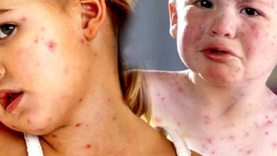 Photo of खसरा के बारे में पैरेंट्स को क्या पता होना चाहिए जाने?