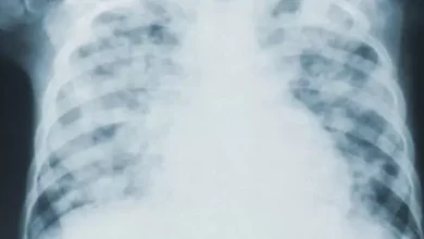 Photo of जानिए सीने में इन्फेक्शन और निमोनिया के मामले से कैसे रखे खुद को दूर..