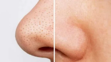 Photo of ब्लैक हेड्स की समस्या से छुटकारा पाने के लिए अपनाएं ये घरेलू नुस्खे..