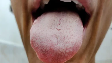 Photo of सफेद जीभ से छुटकारा पाने के लिए , जानें कुछ बेहतरीन घरेलू उपचार?