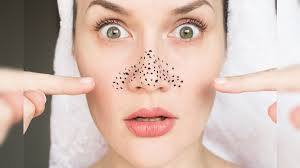 Photo of क्यों होते हैं व्हाइटहेड्स जानें?