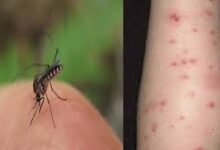 Photo of इन घरेलू नुस्खों से करें मच्छरों के काटने का इलाज, जानें?