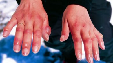 Photo of ठंडी जगहों पर अगर हो जाए फ्रॉस्ट बाइट का अटैक