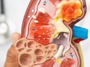 Photo of यूरिन में नजर आते हैं किडनी डैमेज के संकेत