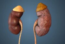 Photo of क्या किडनी स्टोन के मरीजों को तला-भुना खाना चाहिए
