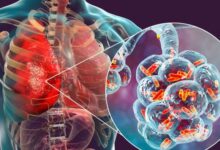 Photo of बुखार मे ऐसे करे निमोनिया के संकेतो की पहचान