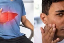 Photo of त्वचा पर नजर आते हैं लिवर की खराबी के 5 लक्षण