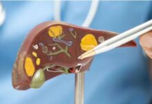 Photo of ज्यादा तला-भुना और फैटी खाना बन सकता है लिवर कैंसर की वजह