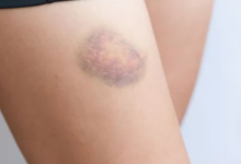 Photo of बिना चोट लगे क्यों पड़ जाते हैं शरीर पर नीले निशान?