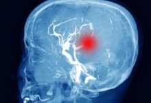 Photo of ब्रेन इंजरी के बाद ‘साइलेंट किलर’ बन सकता है हाइड्रोसिफलस